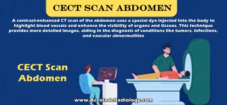 CECT scan of abdomen