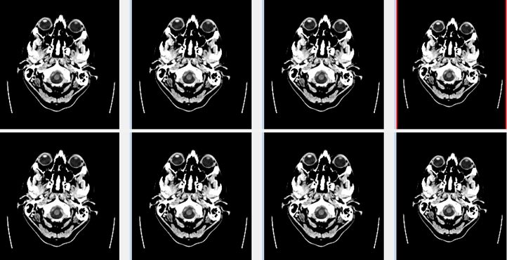 CT scan Brain/Head (plain)