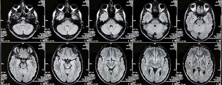 CT scan Brain/Head with contrast